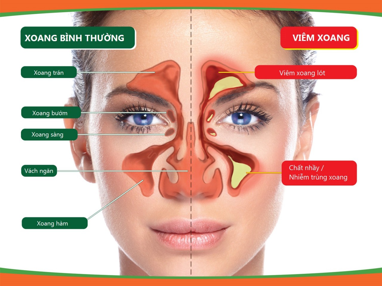 bệnh viêm xoang